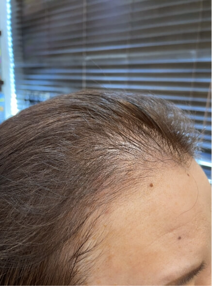 施術事例のBEFORE画像