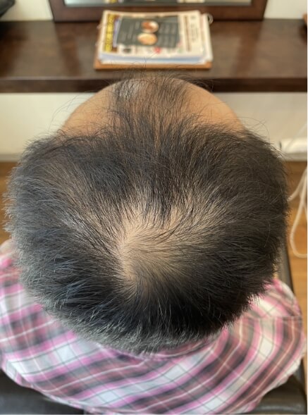 施術事例のBEFORE画像