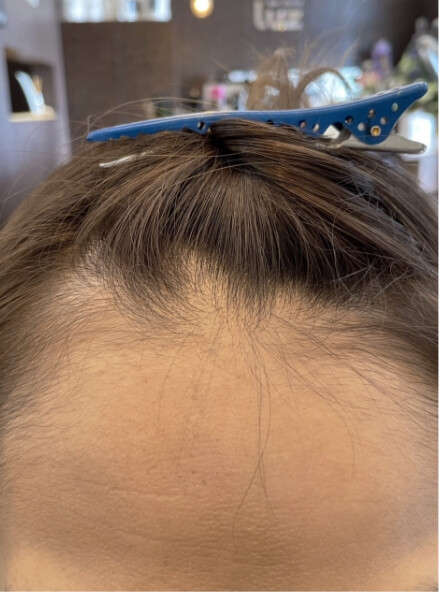 施術事例のBEFORE画像