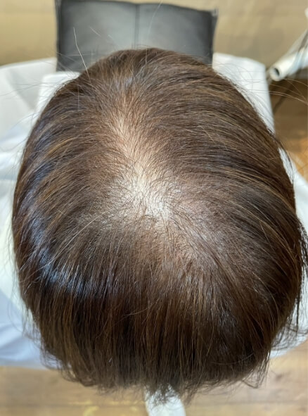 施術事例のBEFORE画像