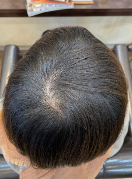施術事例のAFTER画像
